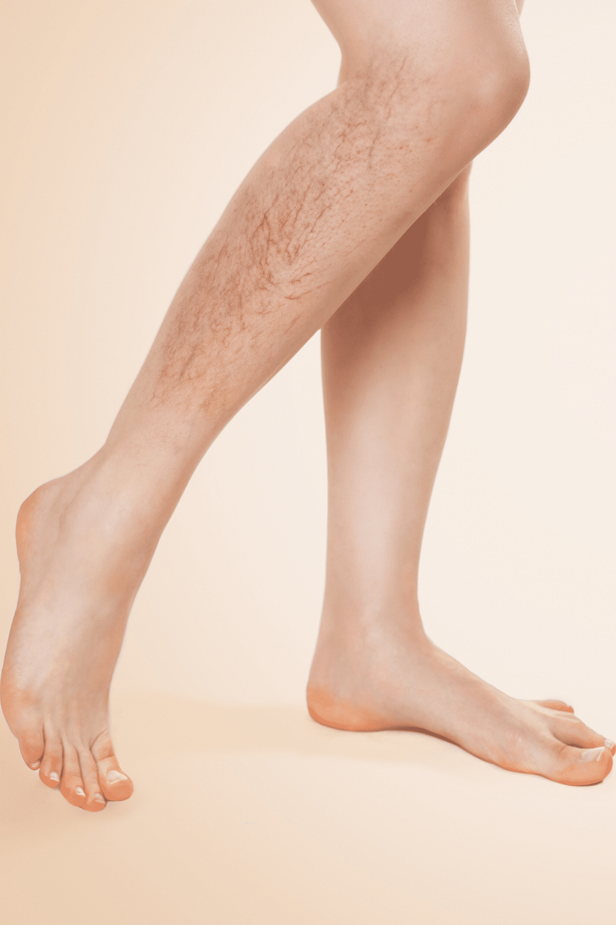 Sichtbare Venen auf der Haut an den Beinen - sogenannte Besenreiser