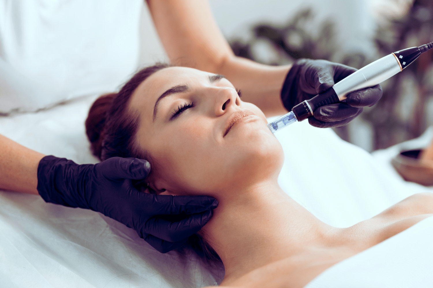 Frau unterzieht sich einer medizinischen Microneedling Behandlung in Nürnberg