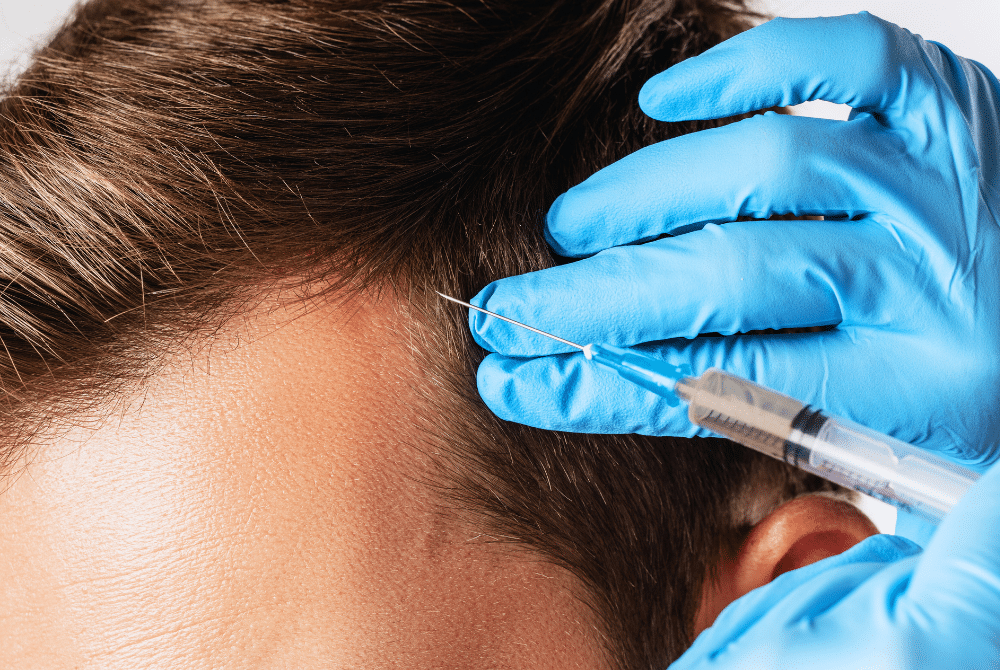 Mann lässt sich aufgrund des Rückgangs des Haaransatz in den Geheimratsecken mittels eines wirksamem Serums aus Eigenblut, das PRP enthält, die Haarwurzel stärken für volleres Haar