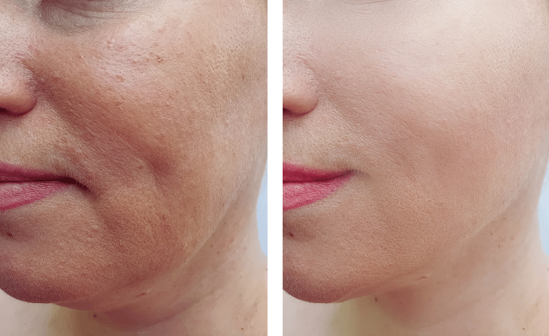 RF-Microneedling-Vorher-Nachher-Bild